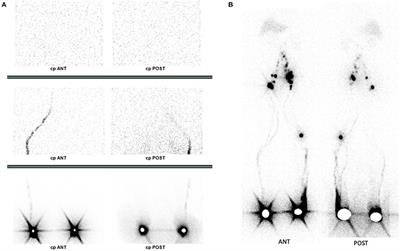 Case Report: Potential Applications of Using a 3D-Ring CZT SPECT for Lymphoscintigraphic Exploration of Lower Limb Edema